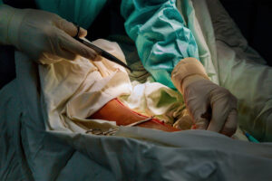 Cytoreductive-Surgery-and-HIPEC