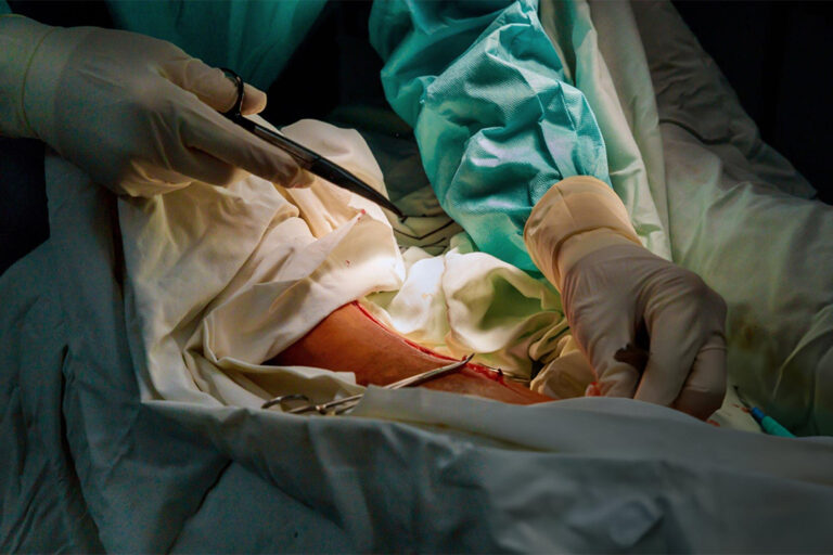 Cytoreductive-Surgery-and-HIPEC